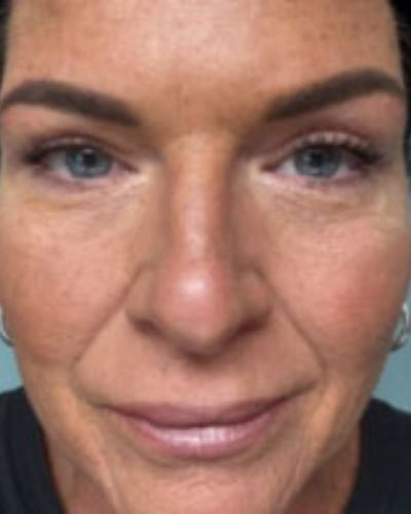 Eyelid Lift Before & After Gallery - Patient 120387 - Image 2