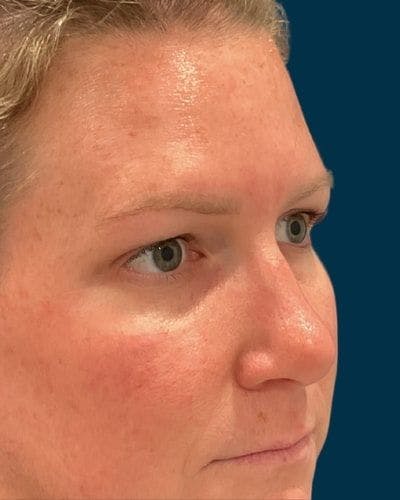 Eyelid Lift Before & After Gallery - Patient 268675 - Image 1