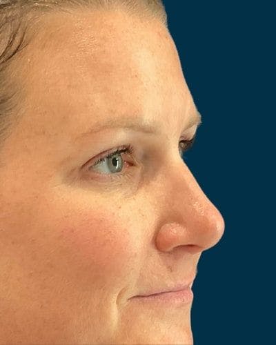 Eyelid Lift Before & After Gallery - Patient 268675 - Image 2