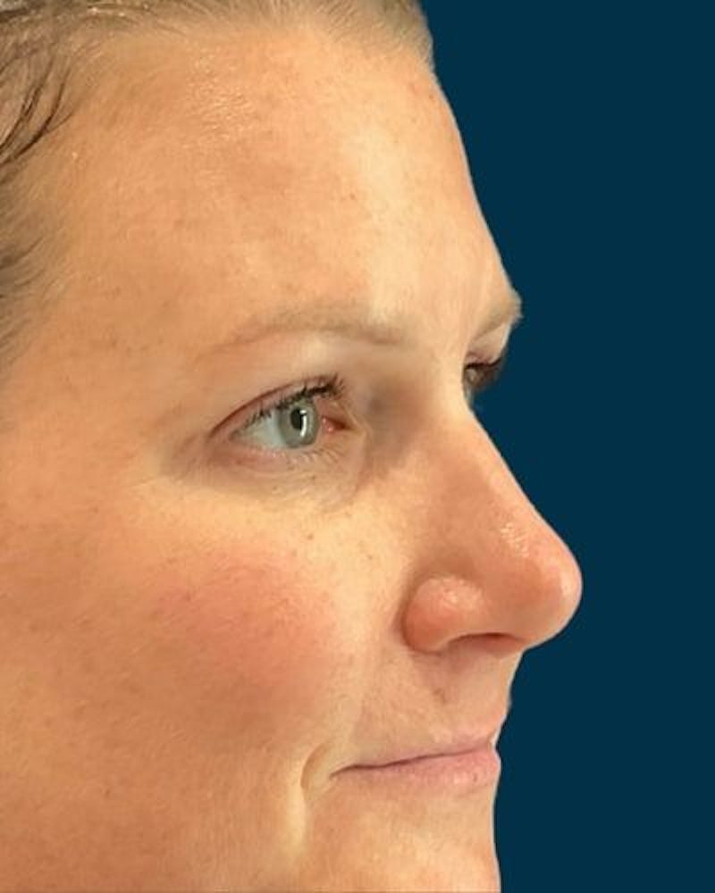 Eyelid Lift Before & After Gallery - Patient 268675 - Image 2
