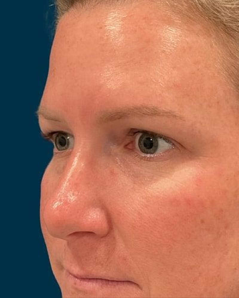 Eyelid Lift Before & After Gallery - Patient 268675 - Image 3