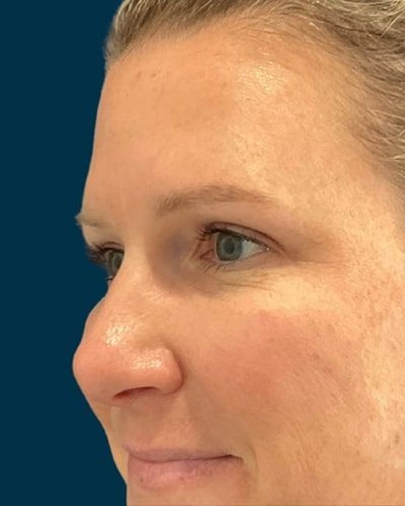 Eyelid Lift Before & After Gallery - Patient 268675 - Image 4
