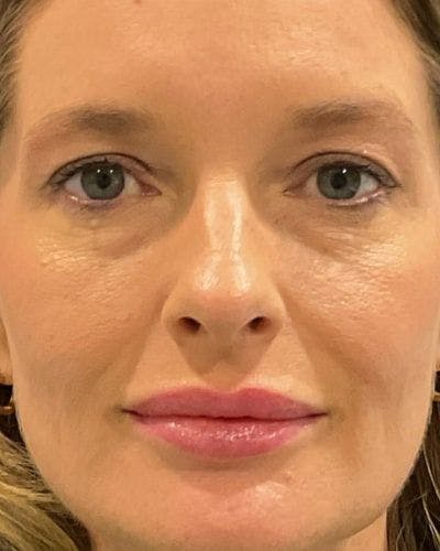 Eyelid Lift Before & After Gallery - Patient 981158 - Image 1