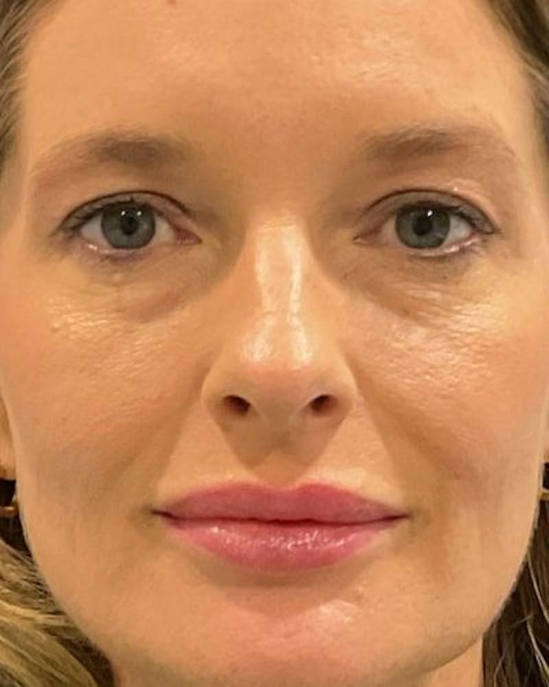 Eyelid Lift Before & After Gallery - Patient 981158 - Image 1