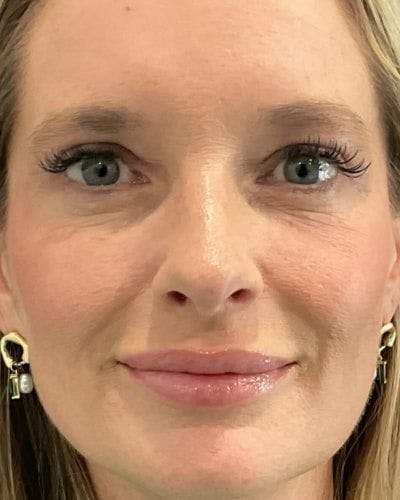 Eyelid Lift Before & After Gallery - Patient 981158 - Image 2