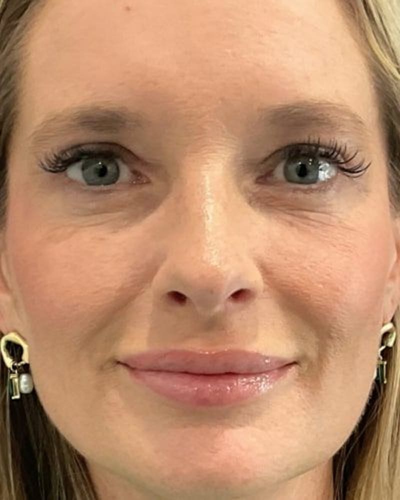 Eyelid Lift Before & After Gallery - Patient 981158 - Image 2