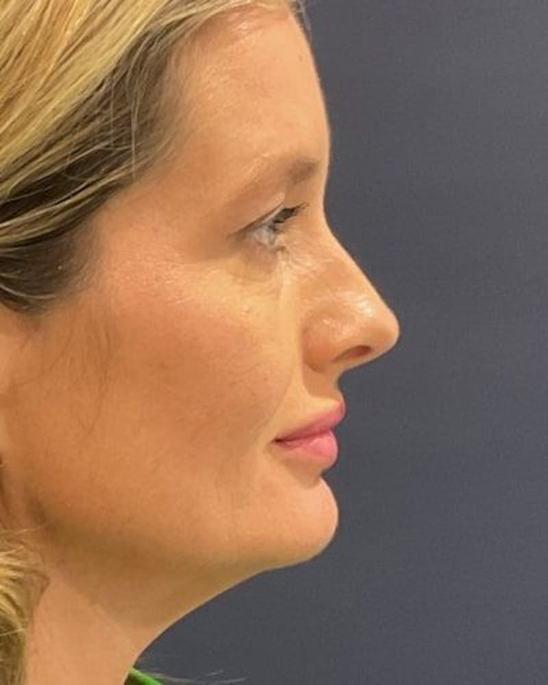 Eyelid Lift Before & After Gallery - Patient 981158 - Image 3