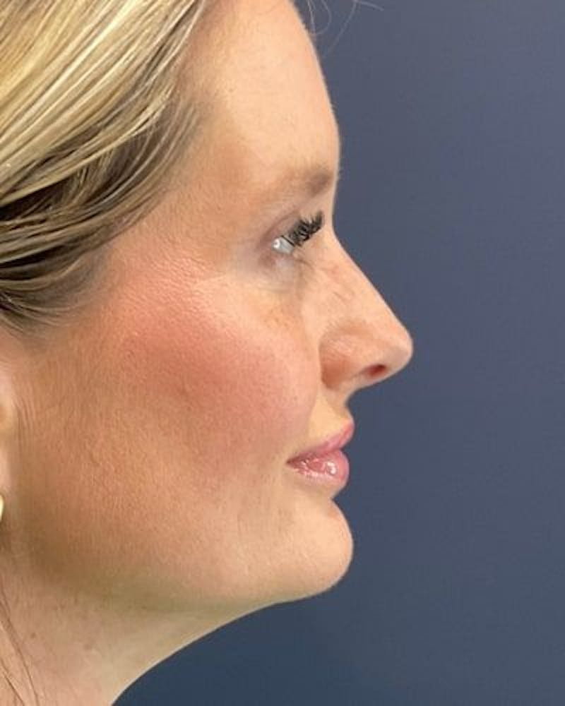 Eyelid Lift Before & After Gallery - Patient 981158 - Image 4