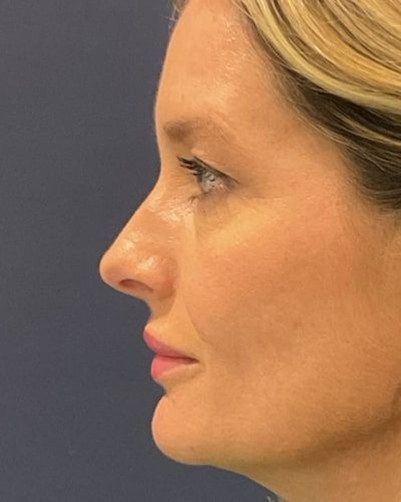 Eyelid Lift Before & After Gallery - Patient 981158 - Image 5