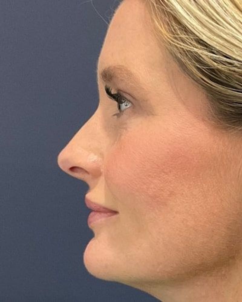 Eyelid Lift Before & After Gallery - Patient 981158 - Image 6
