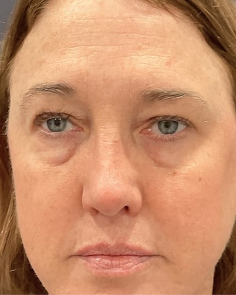 Eyelid Lift Before & After Gallery - Patient 239243 - Image 1