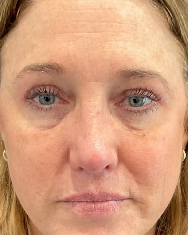 Eyelid Lift Before & After Gallery - Patient 239243 - Image 2