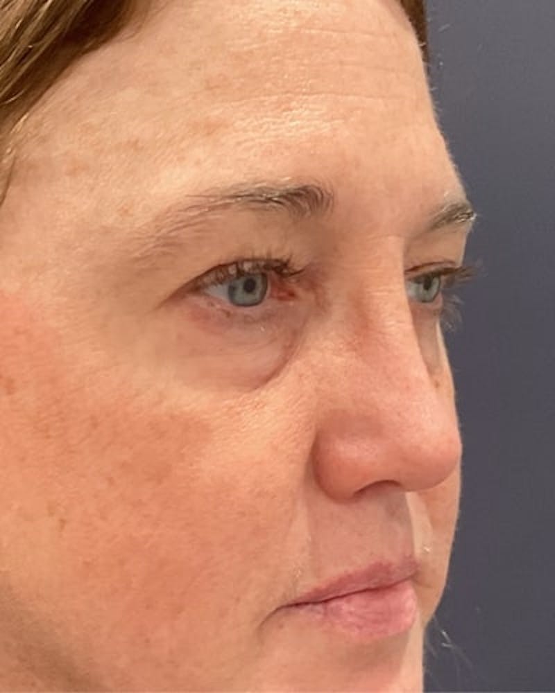 Eyelid Lift Before & After Gallery - Patient 239243 - Image 3