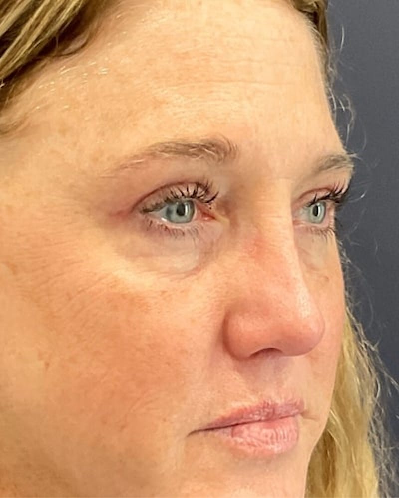 Eyelid Lift Before & After Gallery - Patient 239243 - Image 4
