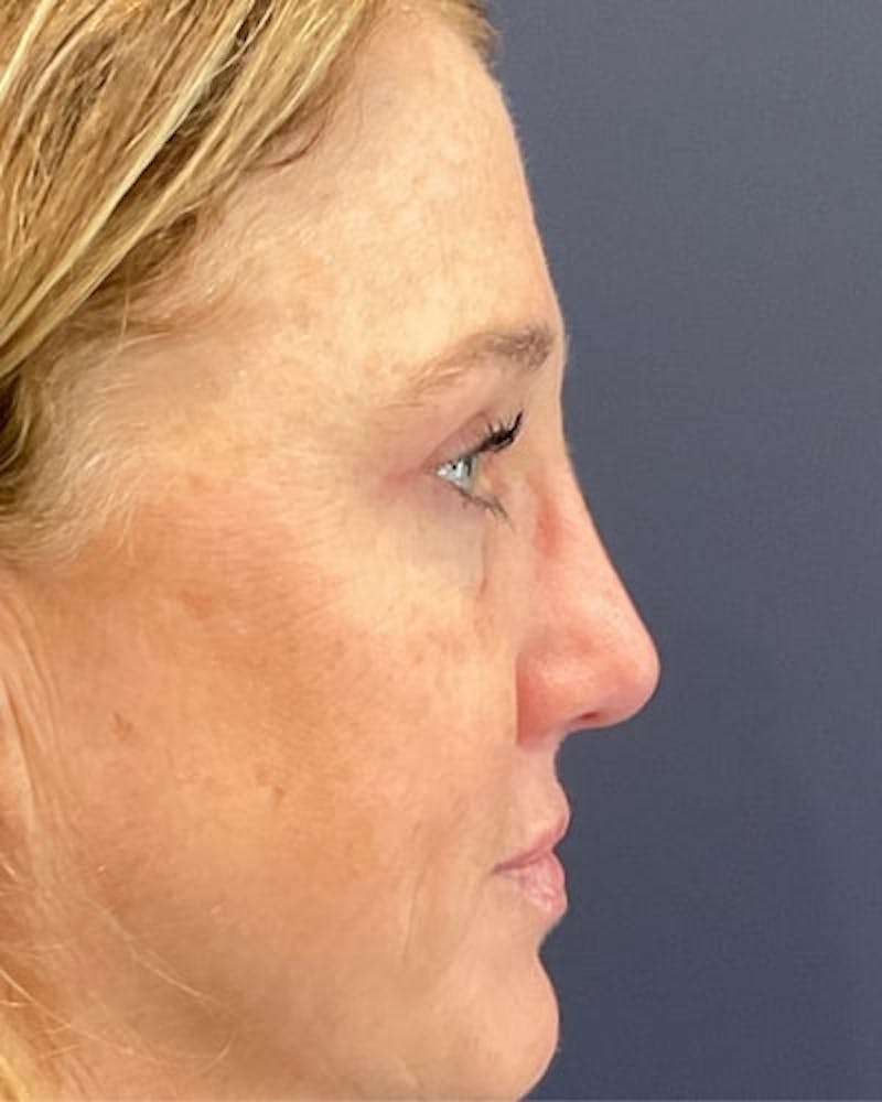 Eyelid Lift Before & After Gallery - Patient 239243 - Image 5
