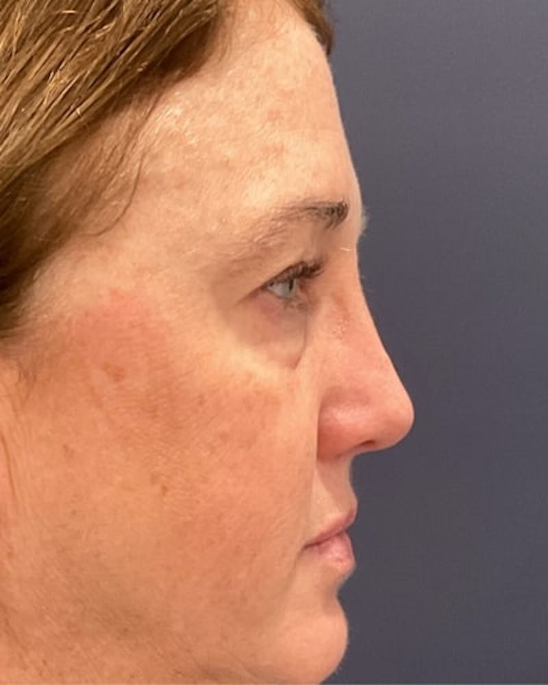 Eyelid Lift Before & After Gallery - Patient 239243 - Image 6