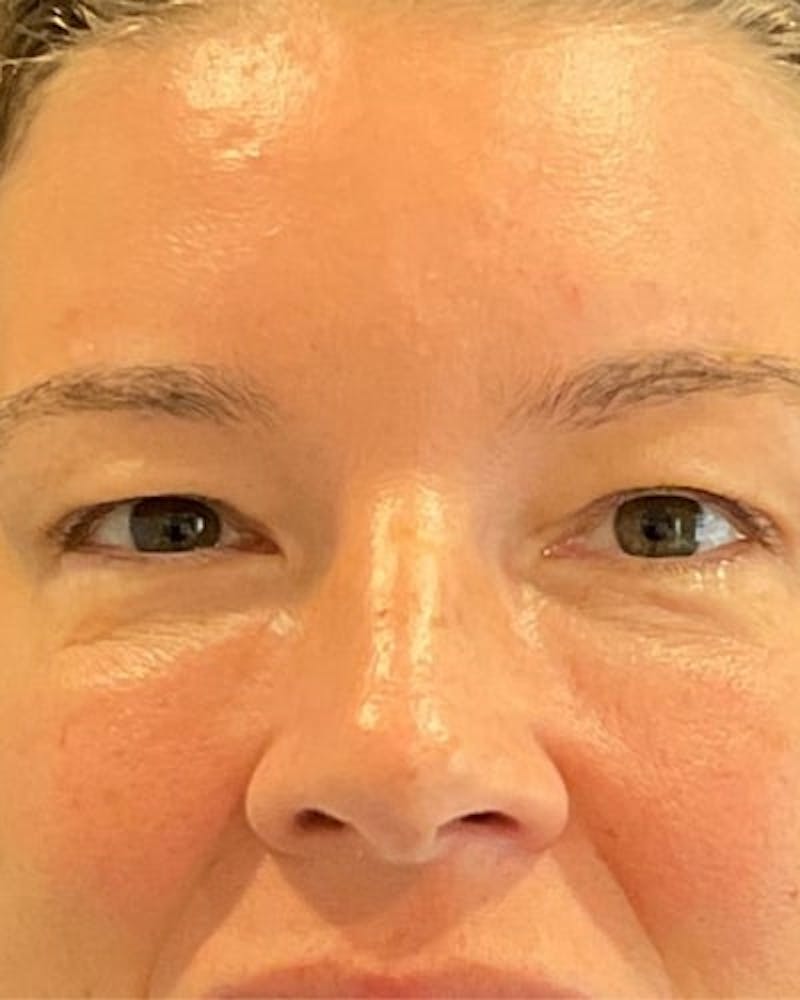 Eyelid Lift Before & After Gallery - Patient 402070 - Image 1