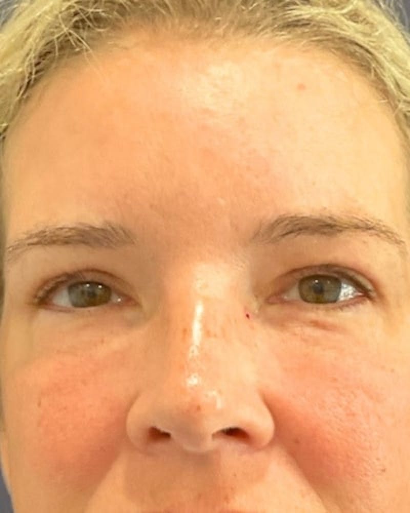 Eyelid Lift Before & After Gallery - Patient 402070 - Image 2