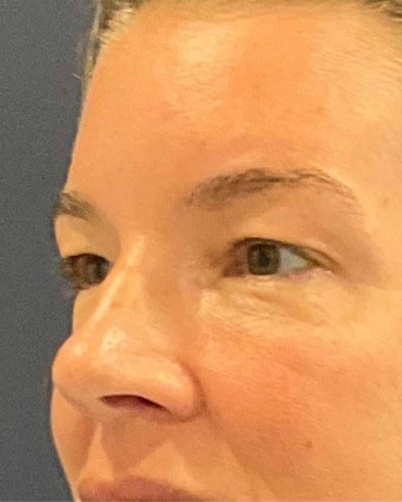 Eyelid Lift Before & After Gallery - Patient 402070 - Image 3