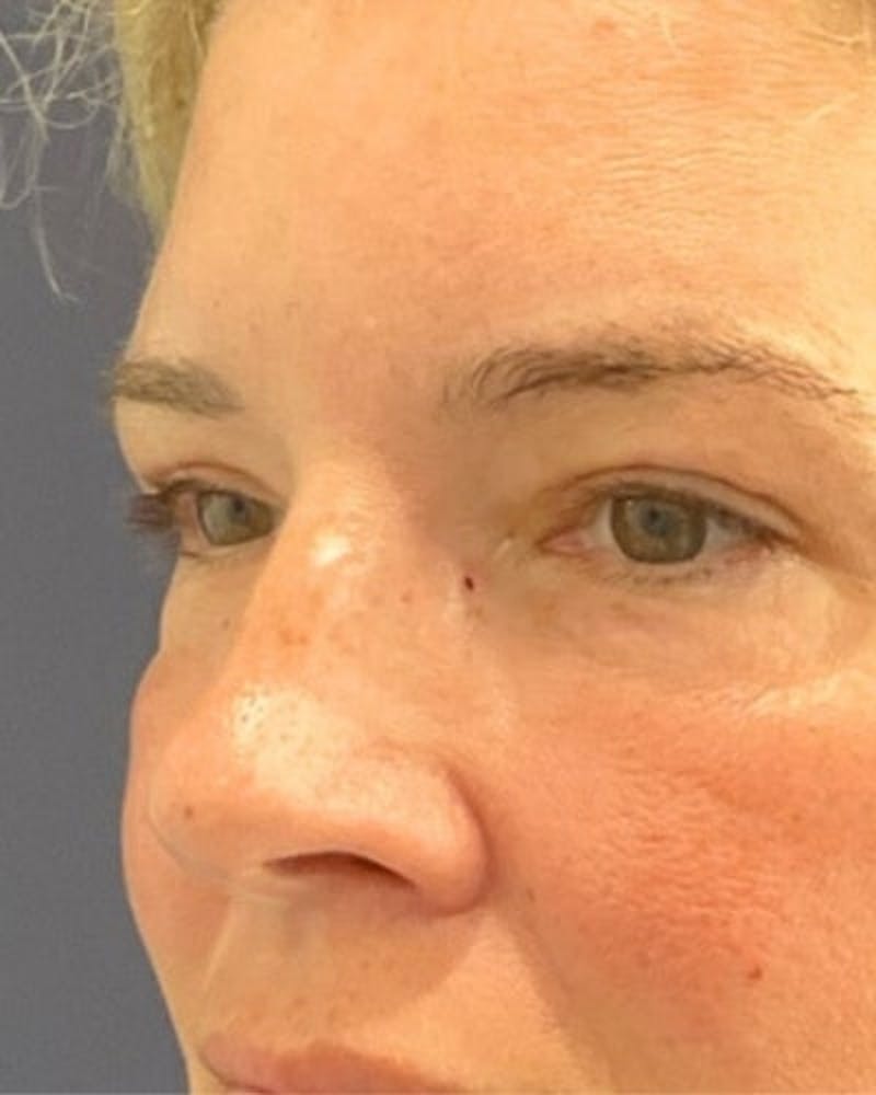 Eyelid Lift Before & After Gallery - Patient 402070 - Image 4