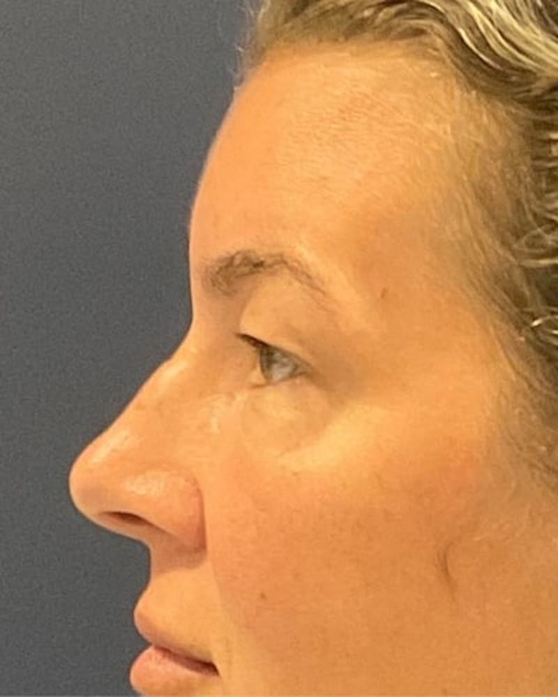 Eyelid Lift Before & After Gallery - Patient 402070 - Image 5