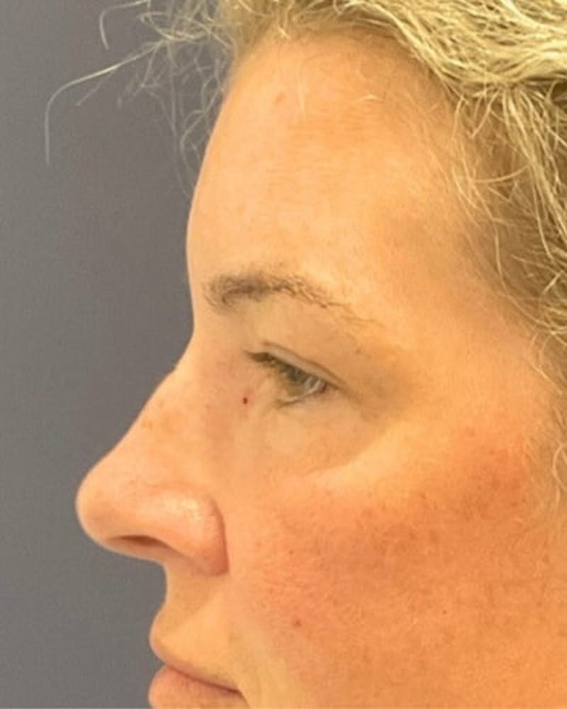 Eyelid Lift Before & After Gallery - Patient 402070 - Image 6