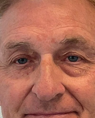 Eyelid Lift Before & After Gallery - Patient 181631 - Image 1