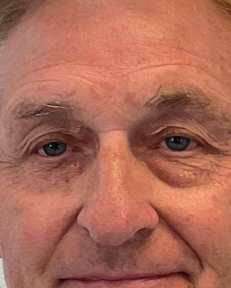 Eyelid Lift Before & After Gallery - Patient 181631 - Image 1