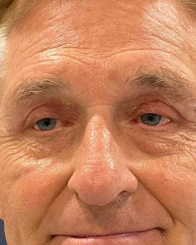Eyelid Lift Before & After Gallery - Patient 181631 - Image 2