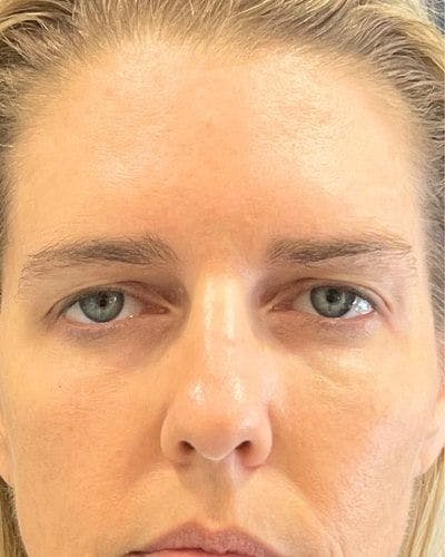Eyelid Lift Before & After Gallery - Patient 282332 - Image 1