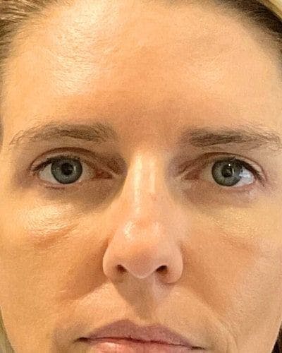 Eyelid Lift Before & After Gallery - Patient 282332 - Image 2