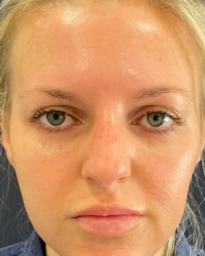 Eyelid Lift Before & After Gallery - Patient 291065 - Image 1
