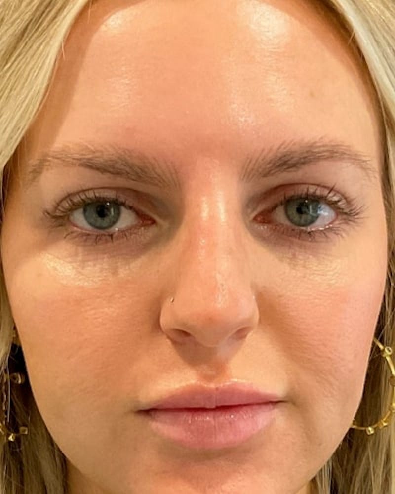 Eyelid Lift Before & After Gallery - Patient 291065 - Image 2