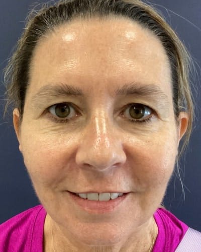 Eyelid Lift Before & After Gallery - Patient 507507 - Image 1