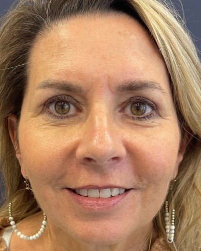 Eyelid Lift Before & After Gallery - Patient 507507 - Image 2
