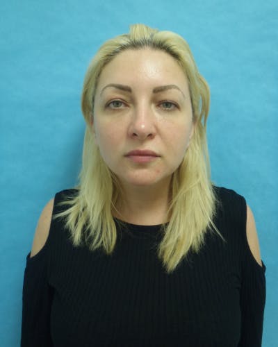Eyelid Lift Before & After Gallery - Patient 132641 - Image 1