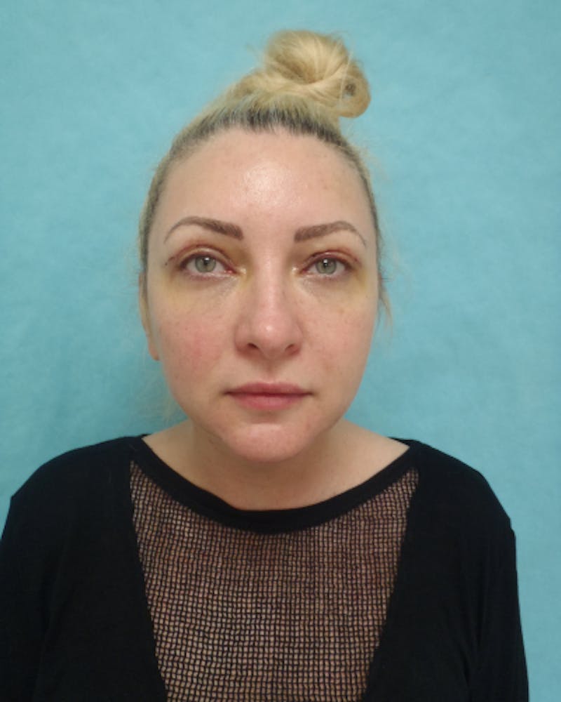 Eyelid Lift Before & After Gallery - Patient 132641 - Image 2
