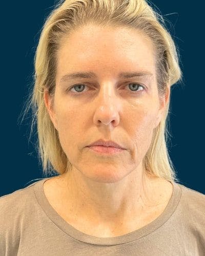 Facelift and Neck Lift Before & After Gallery - Patient 213053 - Image 1