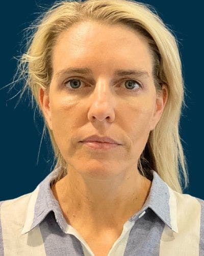 Facelift and Neck Lift Before & After Gallery - Patient 213053 - Image 2
