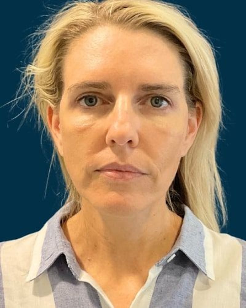 Facelift and Neck Lift Before & After Gallery - Patient 213053 - Image 2