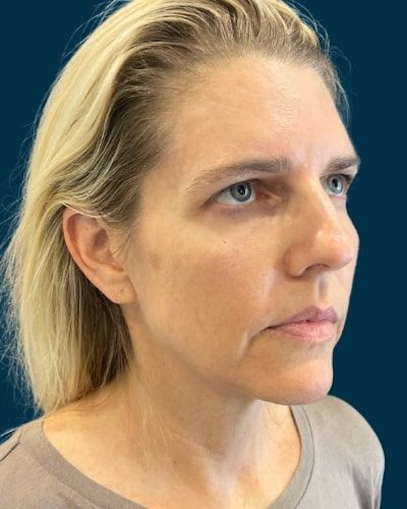 Facelift and Neck Lift Before & After Gallery - Patient 213053 - Image 3