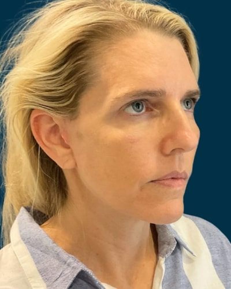 Facelift and Neck Lift Before & After Gallery - Patient 213053 - Image 4