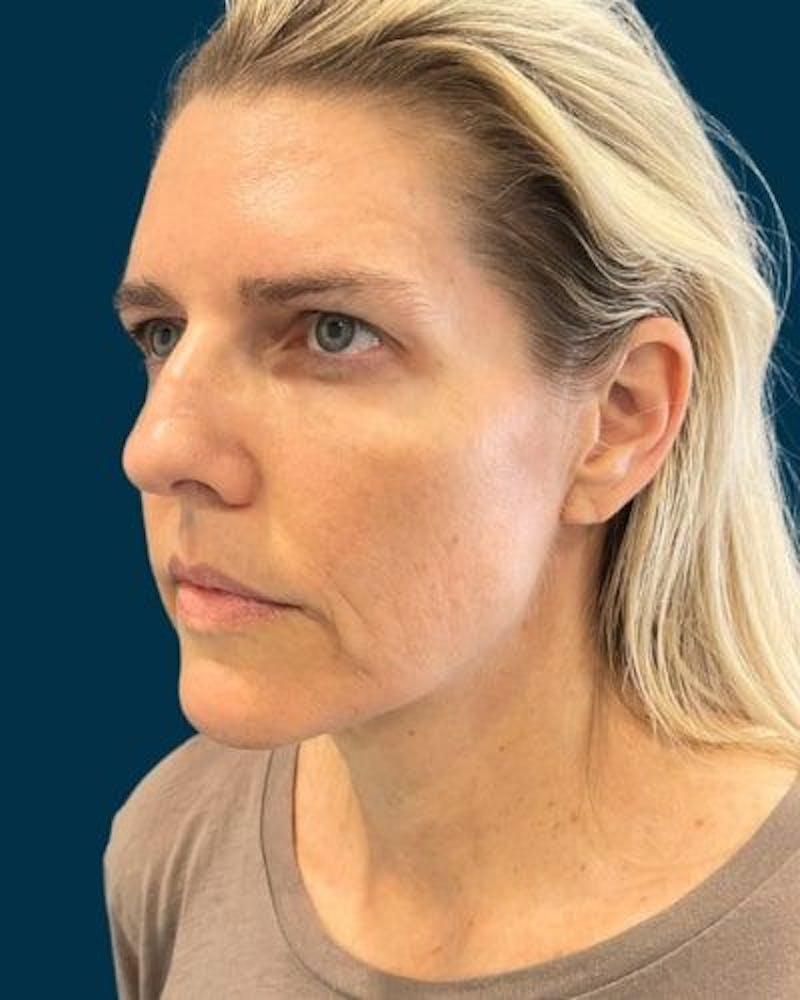 Facelift and Neck Lift Before & After Gallery - Patient 213053 - Image 5