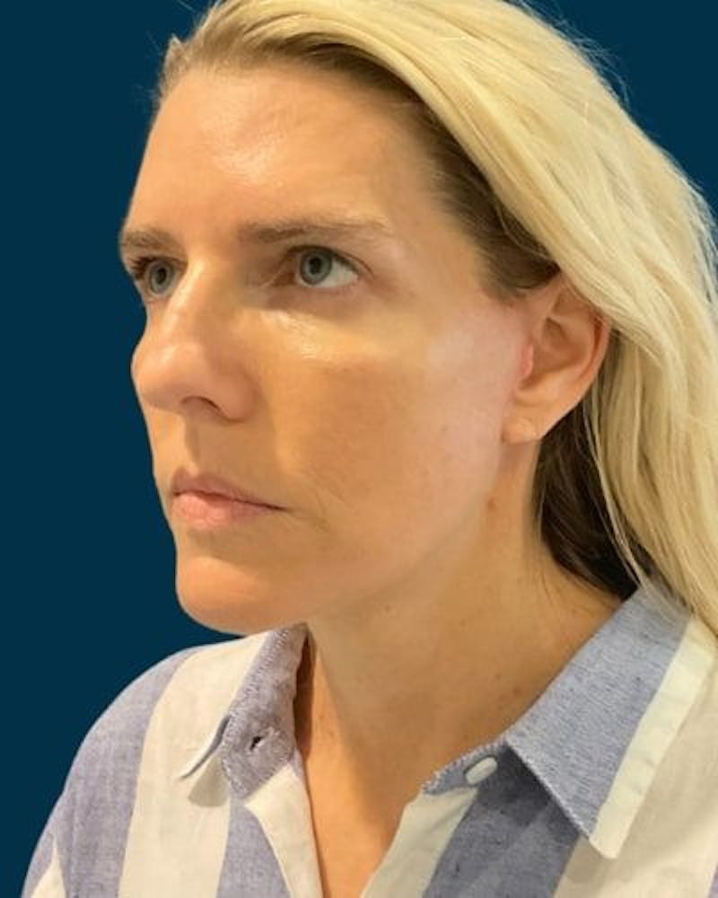 Facelift and Neck Lift Before & After Gallery - Patient 213053 - Image 6