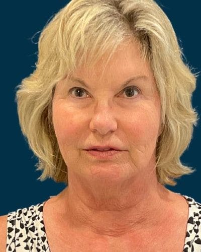 Facelift and Neck Lift Before & After Gallery - Patient 154719 - Image 1