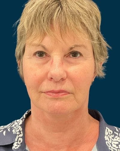 Facelift and Neck Lift Before & After Gallery - Patient 154719 - Image 2