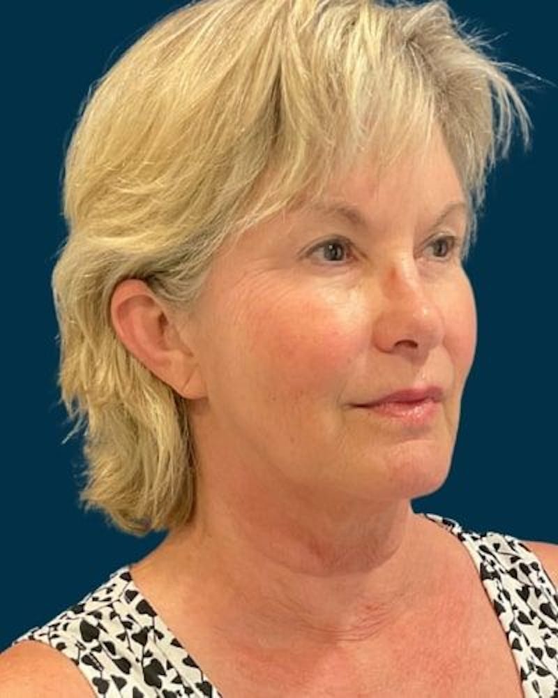 Facelift and Neck Lift Before & After Gallery - Patient 154719 - Image 3