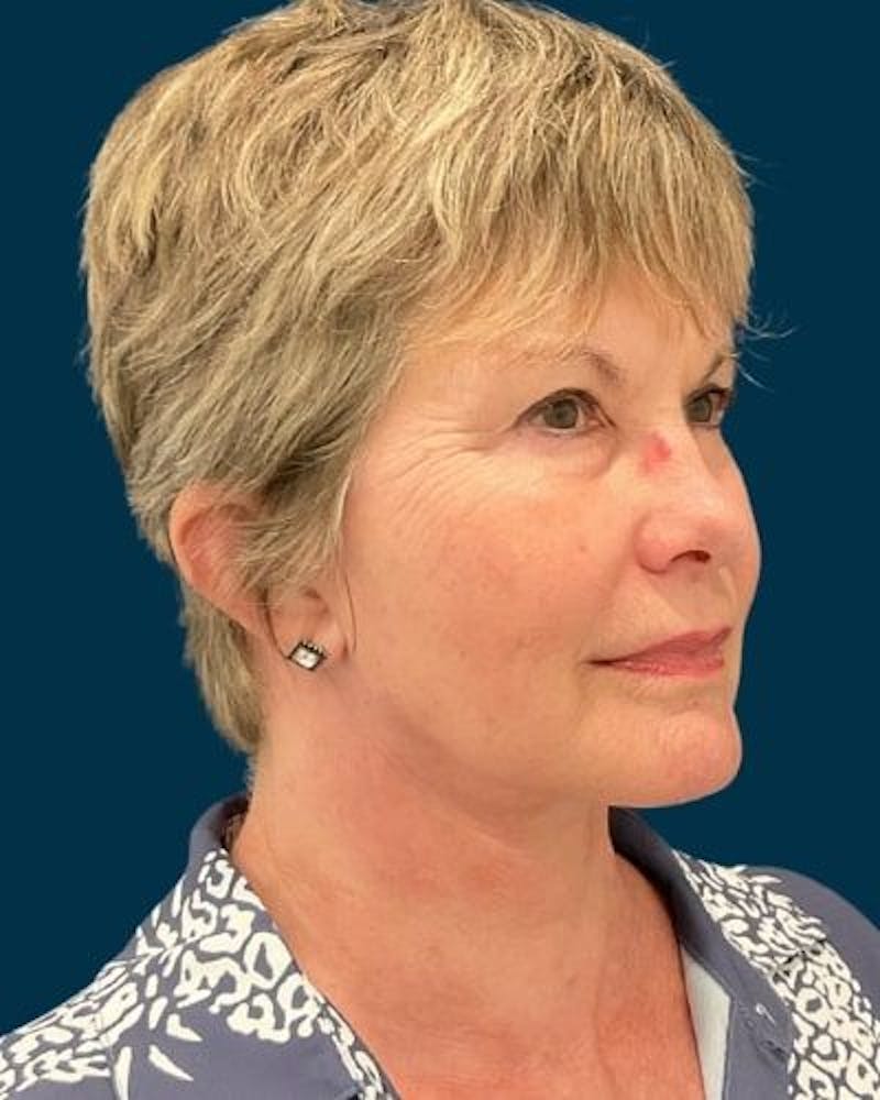 Facelift and Neck Lift Before & After Gallery - Patient 154719 - Image 4