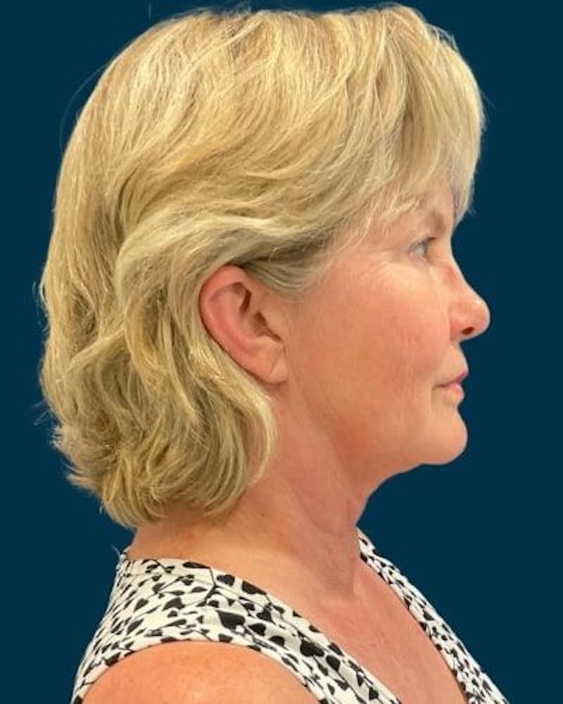 Facelift and Neck Lift Before & After Gallery - Patient 154719 - Image 5