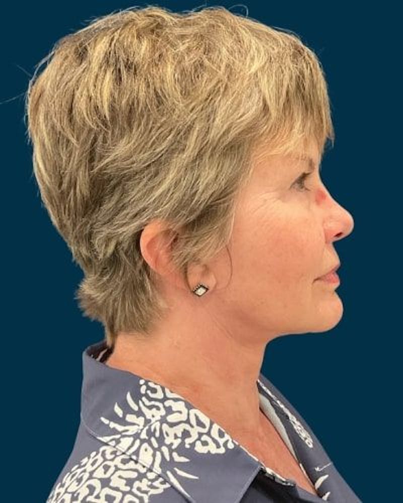 Facelift and Neck Lift Before & After Gallery - Patient 154719 - Image 6